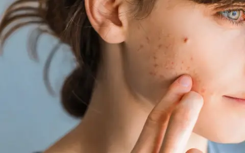 Primo piano del viso di una giovane donna con pelle invecchiata dal sole, macchie e brufoli.