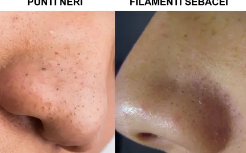 Confronto tra punti neri e filamenti sebacei sul naso. La pelle mostra pori dilatati e imperfezioni.