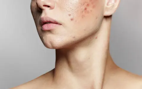 Primo piano del viso di una persona con imperfezioni e pelle secca, evidenziando rossori e brufoli sul collo e sulla guancia.
