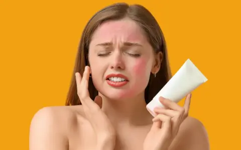 Donna con viso arrossato dal sole, tiene in mano un tubetto bianco, cercando sollievo. Cosa mettere sulle scottature per lenire la pelle.
