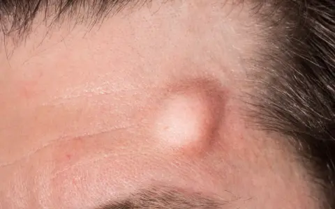 Una protuberanza pelle sulla fronte, circondata da capelli scuri e rughe sottili.
