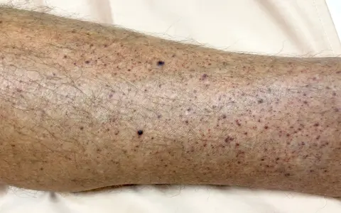 Pelle di una gamba con numerosi puntini rossi e viola, alcuni più scuri, distribuiti su un fondo leggermente arrossato e con peli.