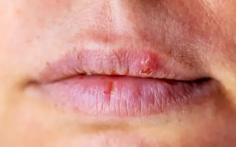 Labbra secche e screpolate, con piccole lesioni e labbra che si ritirano in alcuni punti, mostrando la pelle sottostante.
