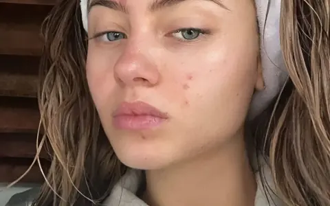 Viso di giovane donna con rossori e brufoli, segni del retinol purging. Capelli castani umidi, fascia bianca in testa.