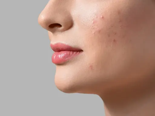 Aha, cos'è! Un primo piano del viso di una donna con rossetto rosa e alcuni brufoli sul viso.