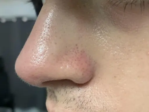 Primo piano del naso con pori visibili e alcuni filamenti sebacei. La pelle è leggermente lucida.