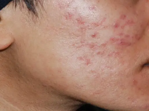 Primo piano del viso con acne cistica, alla ricerca di una cura definitiva.