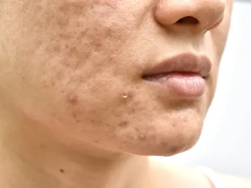 Primo piano del viso con imperfezioni, pori dilatati e brufoli. Potrebbe indicare una carenza di vitamina D nella pelle.
