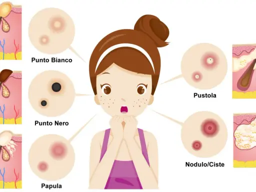 Ragazza con brufoli, punti neri e bianchi, papule, pustole e noduli/cisti. Illustrazione medica.