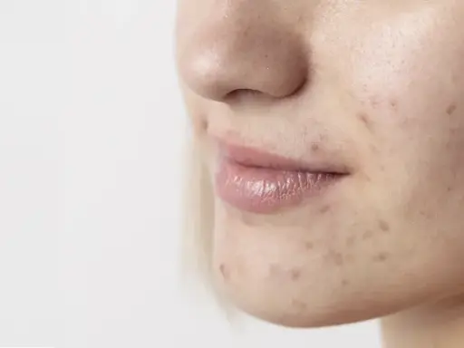 Primo piano del viso di una giovane donna con macchie scure sulla pelle, evidenti segni di acne sul mento e guancia.