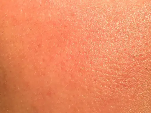 Pelle arrossata e secca, con piccole scaglie visibili. Potrebbe essere un'irritazione da retinolo: cosa fare per lenirla e ripristinare l'idratazione.