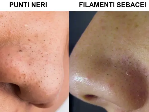 Confronto tra punti neri e filamenti sebacei sul naso. La pelle mostra pori dilatati e imperfezioni.