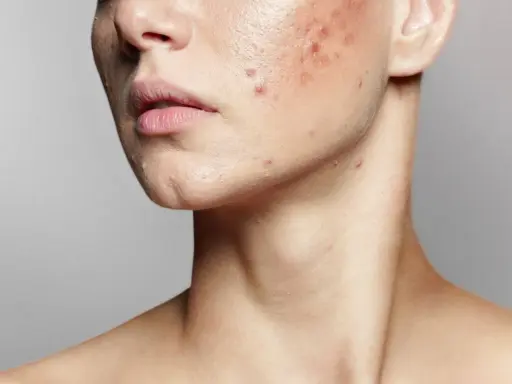 Primo piano del viso di una persona con imperfezioni e pelle secca, evidenziando rossori e brufoli sul collo e sulla guancia.