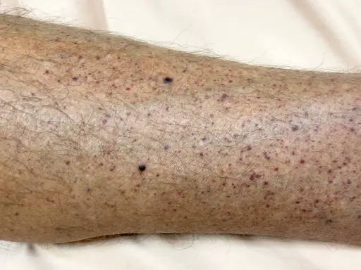 Pelle di una gamba con numerosi puntini rossi e viola, alcuni più scuri, distribuiti su un fondo leggermente arrossato e con peli.