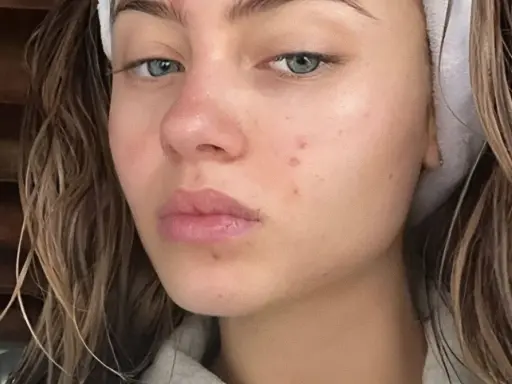 Viso di giovane donna con rossori e brufoli, segni del retinol purging. Capelli castani umidi, fascia bianca in testa.