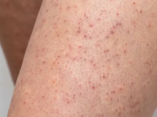 Pelle delle braccia con numerosi piccoli brufoli sottopelle, alcuni rossastri, che creano un aspetto puntinato.