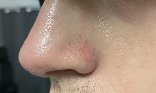 Primo piano del naso con pori visibili e alcuni filamenti sebacei. La pelle è leggermente lucida.