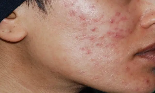 Primo piano del viso con acne cistica, alla ricerca di una cura definitiva.