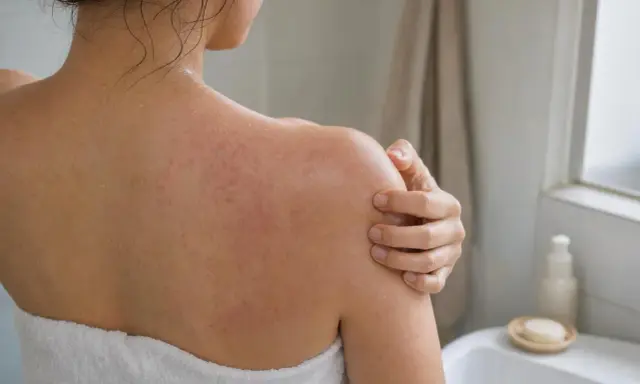 Donna con eruzione cutanea rossa sulla schiena e sulle spalle, che si gratta per il prurito dopo la doccia.
