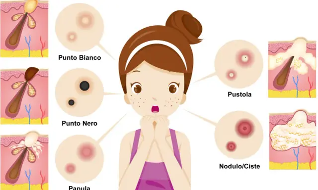 Ragazza con brufoli, punti neri e bianchi, papule, pustole e noduli/cisti. Illustrazione medica.