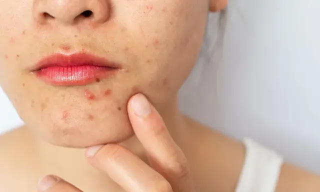 Primo piano del viso di una donna con evidenti segni di acne cistica intorno alla bocca e sul mento.
