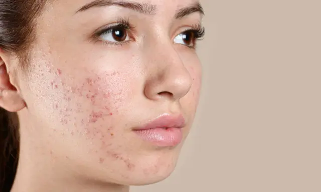 Primo piano del viso di una giovane donna con pelle secca e squamosa, arrossamenti e imperfezioni.