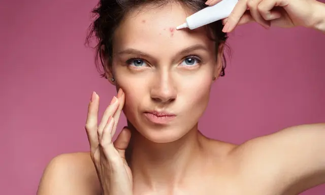 Donna applica tea tree oil su brufolo schiacciato sulla fronte.