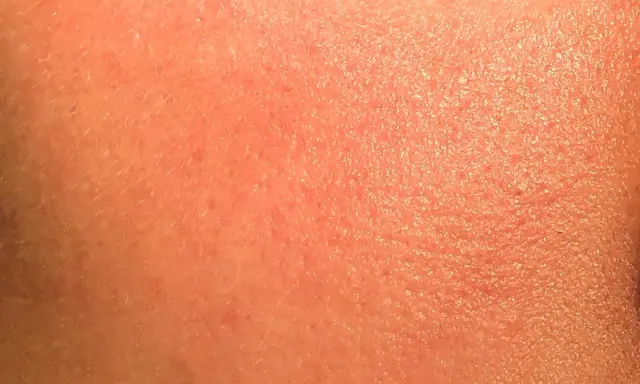 Pelle arrossata e secca, con piccole scaglie visibili. Potrebbe essere un'irritazione da retinolo: cosa fare per lenirla e ripristinare l'idratazione.