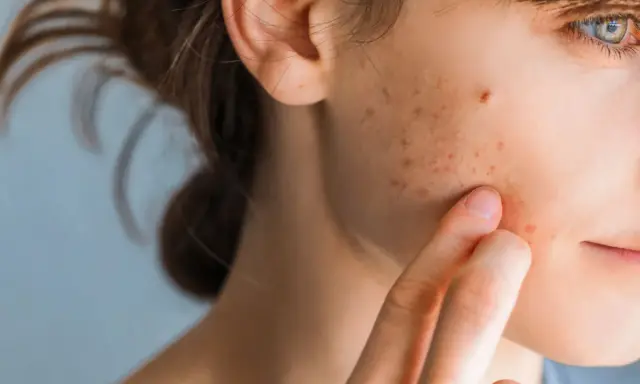 Primo piano del viso di una giovane donna con pelle invecchiata dal sole, macchie e brufoli.