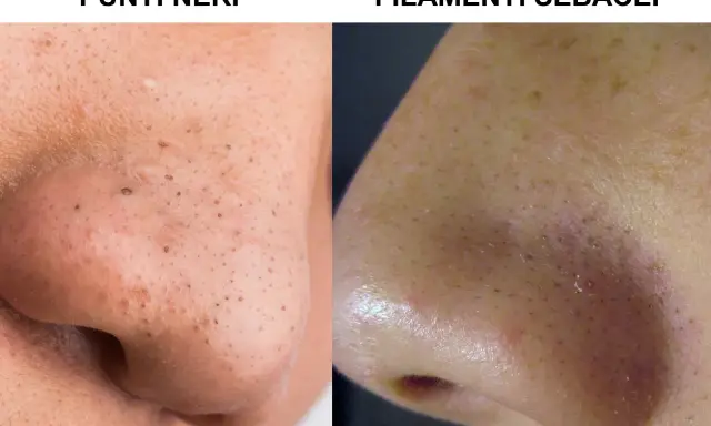 Confronto tra punti neri e filamenti sebacei sul naso. La pelle mostra pori dilatati e imperfezioni.