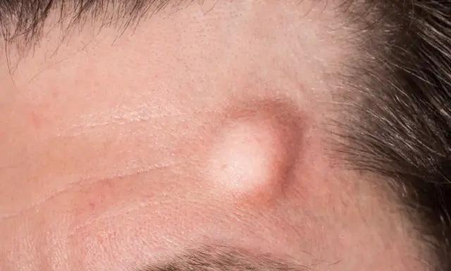 Una protuberanza pelle sulla fronte, circondata da capelli scuri e rughe sottili.