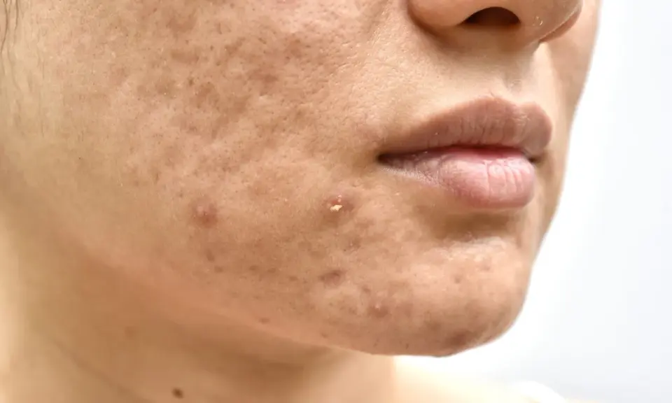 Primo piano del viso con imperfezioni, pori dilatati e brufoli. Potrebbe indicare una carenza di vitamina D nella pelle.