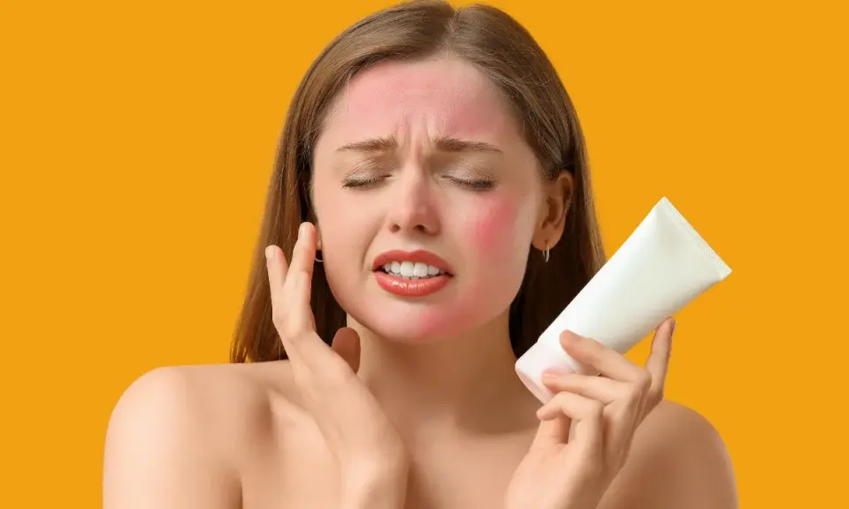 Donna con viso arrossato dal sole, tiene in mano un tubetto bianco, cercando sollievo. Cosa mettere sulle scottature per lenire la pelle.