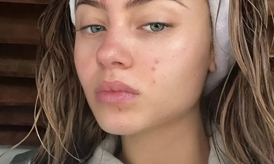 Viso di giovane donna con rossori e brufoli, segni del retinol purging. Capelli castani umidi, fascia bianca in testa.