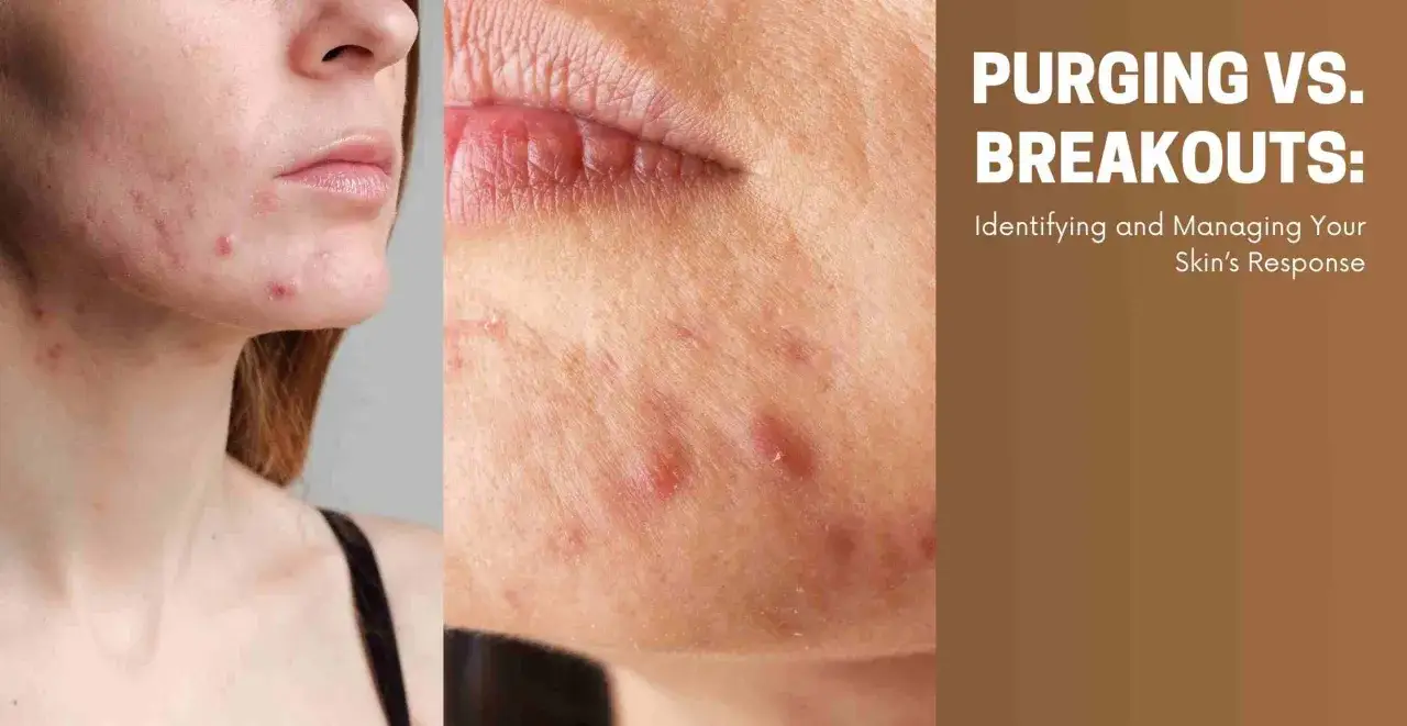 Pelle con brufoli e rossori, un esempio di retinol purging. Impara a distinguere e gestire la tua pelle.