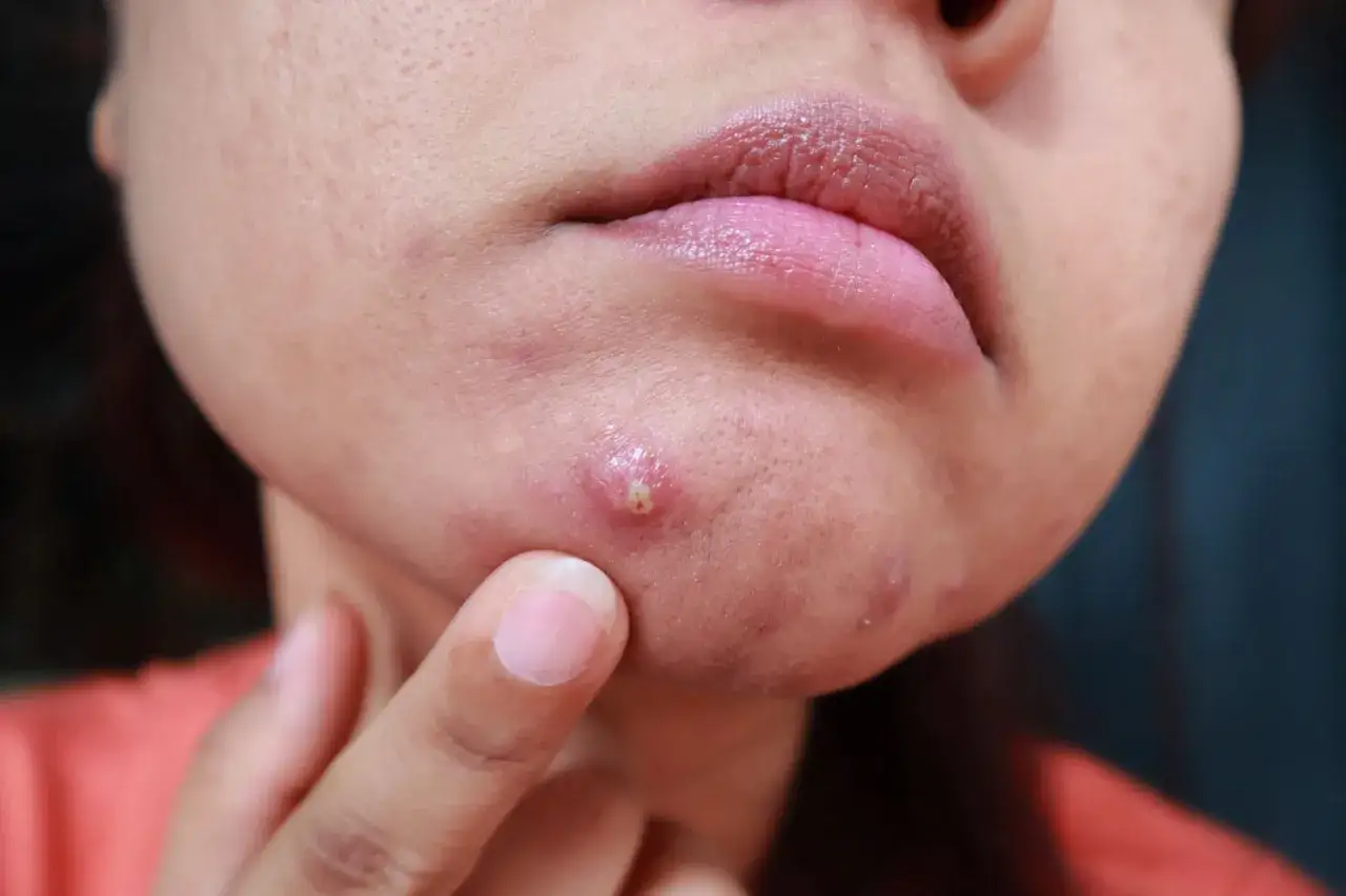 Primo piano del mento con un brufolo infiammato, segno di acne cistica. La pelle circostante presenta rossore e piccole imperfezioni.