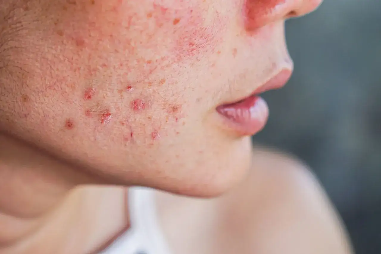 Primo piano del viso con pelle arrossata e imperfezioni, possibile segno di carenza vitamina d pelle.