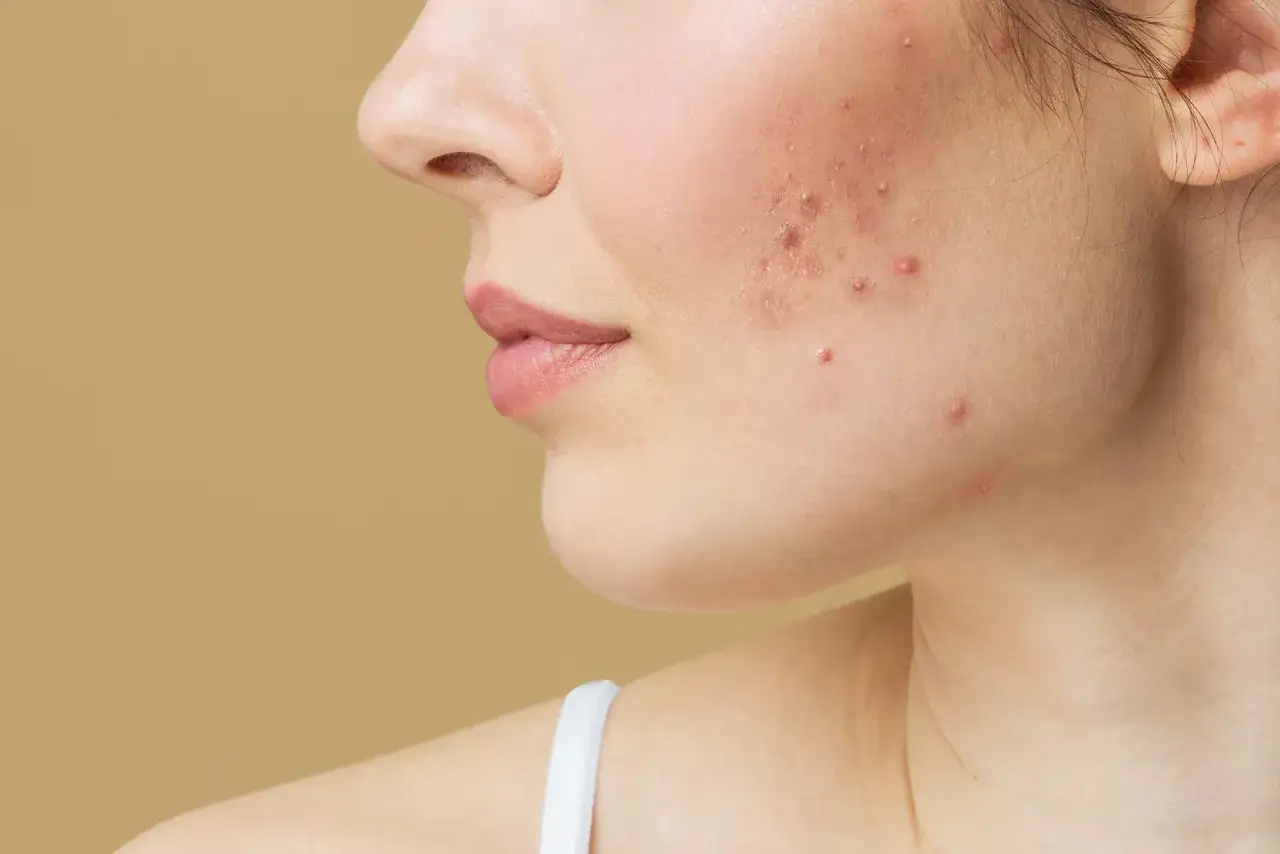 Primo piano del viso di una donna con acne e pelle desquamata, che mostra imperfezioni e arrossamenti.