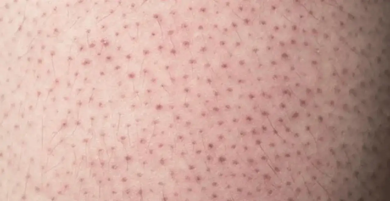 Pelle chiara con numerosi puntini sulle gambe, simili a piccoli pori o follicoli piliferi visibili.