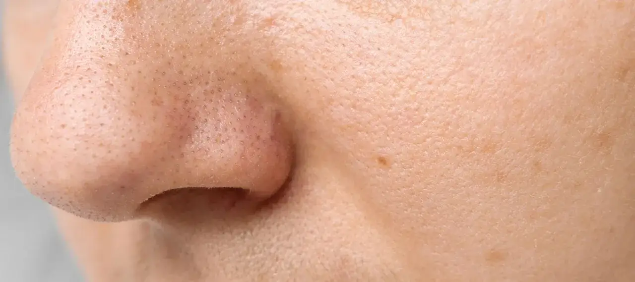 Primo piano del naso con pori dilatati e filamenti sebacei visibili. La pelle mostra una texture irregolare con piccole imperfezioni.