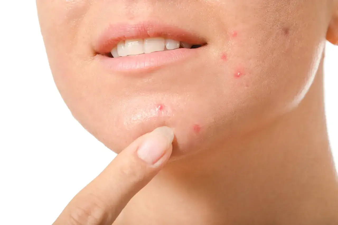Primo piano del volto di una persona con acne cistica. Si cerca una cura definitiva per questo disturbo della pelle.