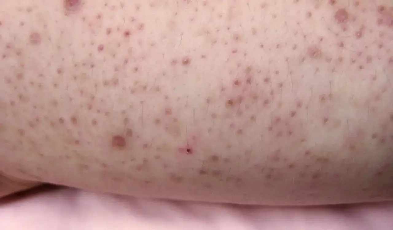 Pelle chiara con numerose piccole bollicine rosse e qualche follicolo pilifero visibile, tipiche di una reazione cutanea sulle braccia.