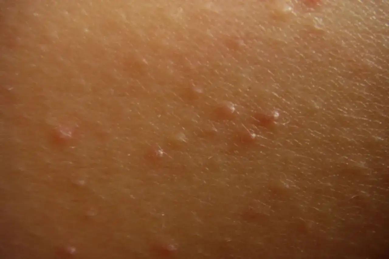 Primo piano della pelle delle braccia con piccoli brufoli sottopelle, alcuni bianchi e altri leggermente arrossati.