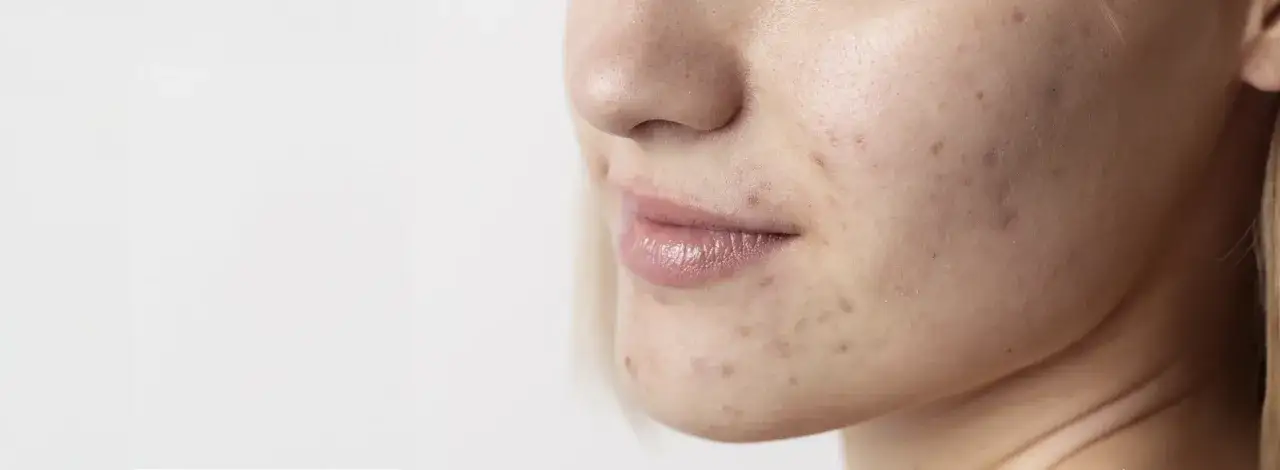 Primo piano di un volto con imperfezioni, pori dilatati e segni di acne, che suggeriscono una pelle invecchiata dal sole.